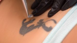 Laser device treating a black tattoo on skin during a removal session