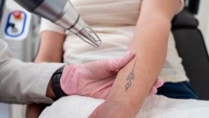 A provider positions a laser handpiece over a small tattoo on a patient's forearm.