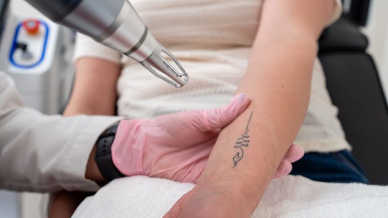 A provider positions a laser handpiece over a small tattoo on a patient's forearm.