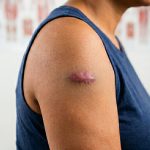 Keloid scar on woman's arm