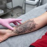 A young woman about to get a tattoo removed