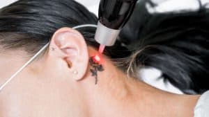 Tattoo being removed by laser