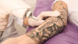 Tattoo being removed by laser.
