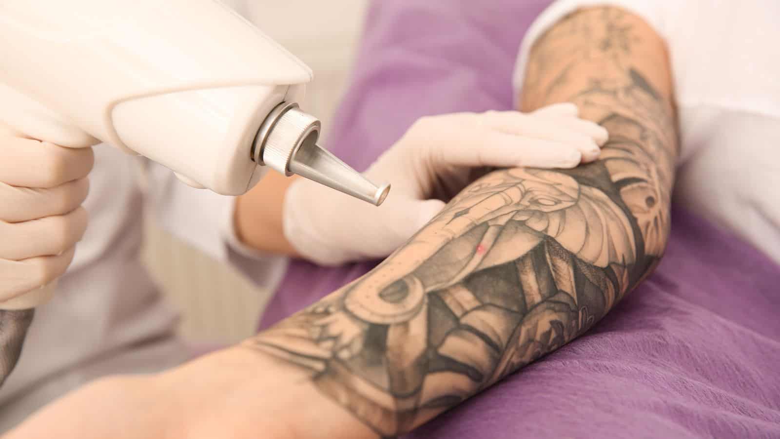 Laser vs. Other Tattoo Removal Methods