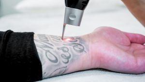 A tattoo being removed with a laser