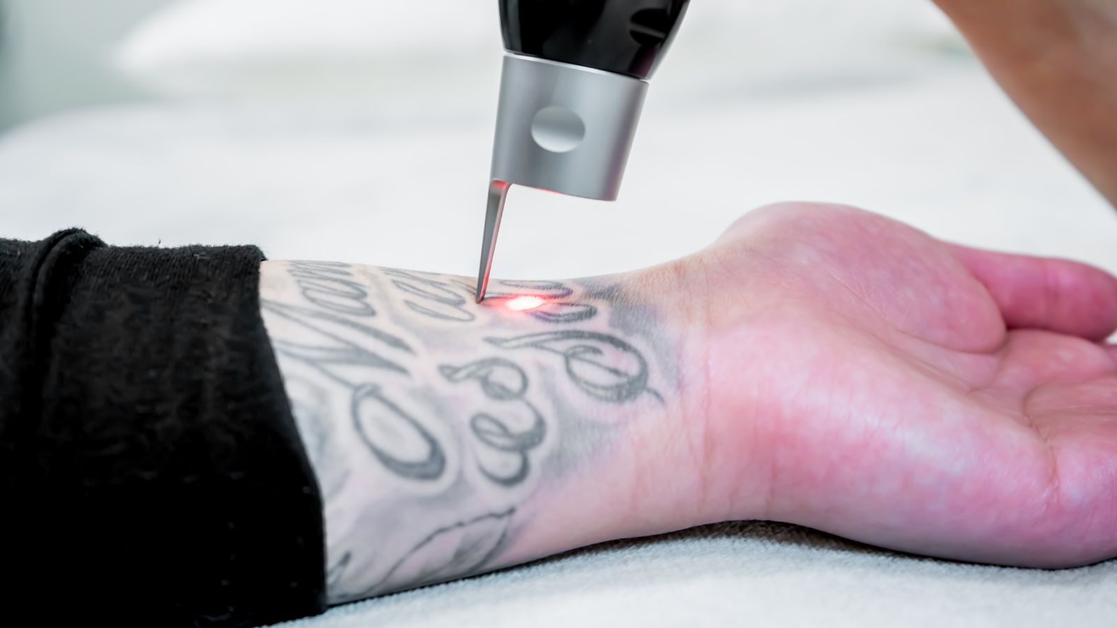 What Actually Happens at a Tattoo Removal Session, Start to Finish
