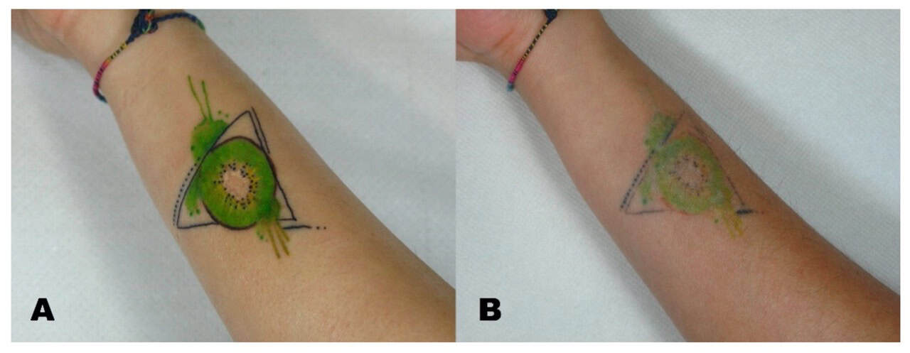 Tattoo Removal Before and After: What the Photos Don’t Show You