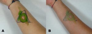 A real before-and-after laser tattoo removal result showing significant fading with some residual ink remaining.