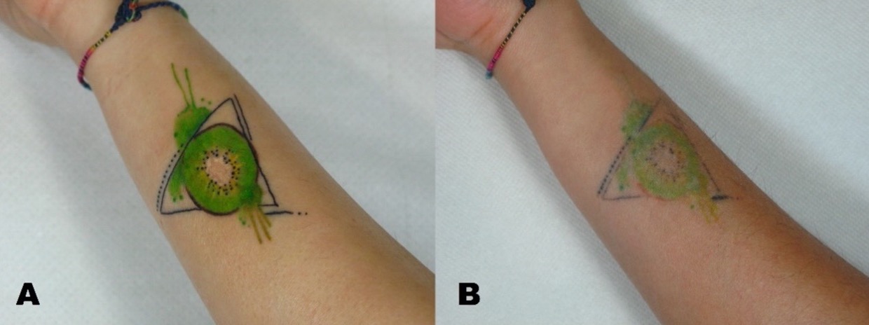 Tattoo Removal Before and After: What the Photos Don’t Show You