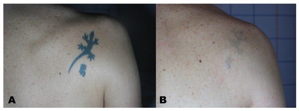 A real before-and-after laser tattoo removal result showing a small blue lizard tattoo on the upper back noticeably faded after treatment, with some ink remaining.