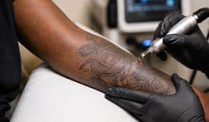 A tattoo removal session on darker skin, illustrating the careful, conservative approach that protects natural skin pigment.