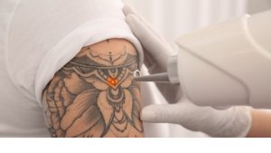 Laser tattoo removal on an arm tattoo